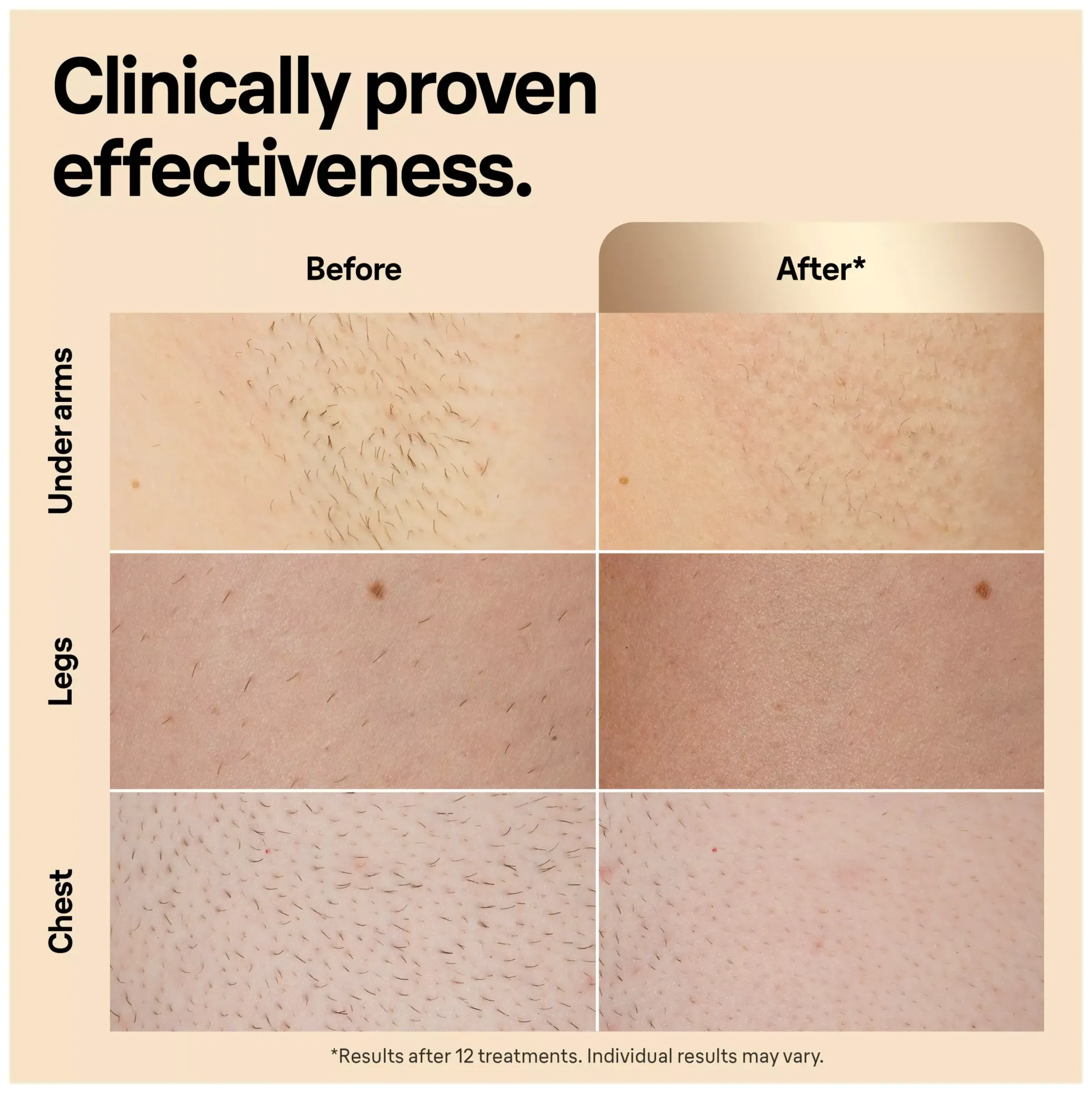Braun IPL Silk·expert Pro 5 At Home Hair Removal With Pouch 1 Head PL5052
