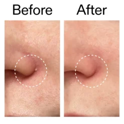 The Inkey List Hydrocolloid Invisible Pimple Patches 22 st